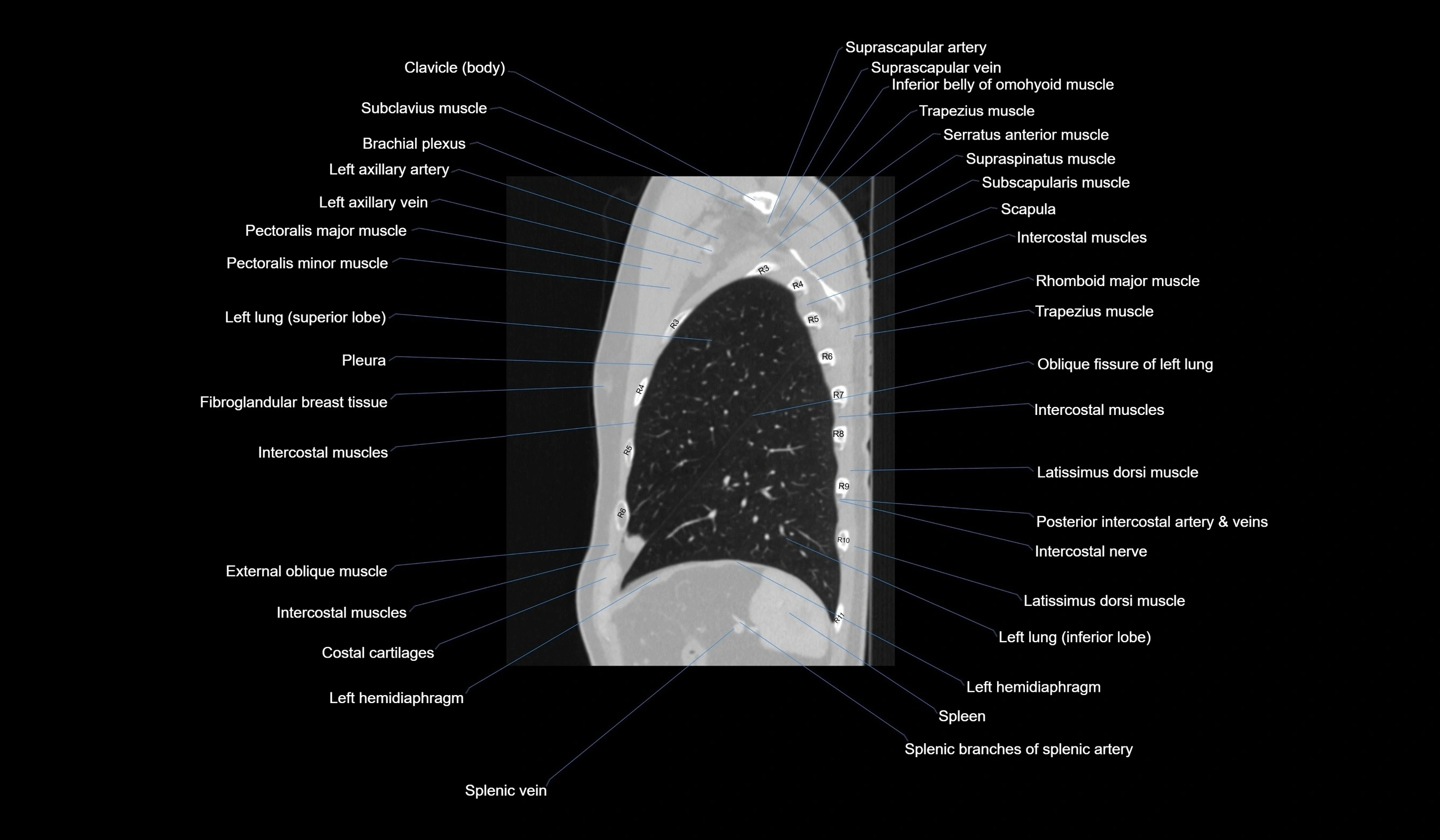CT chest (thorax) labelled sagittal cross sectional anatomy radiology image-00116.webp
